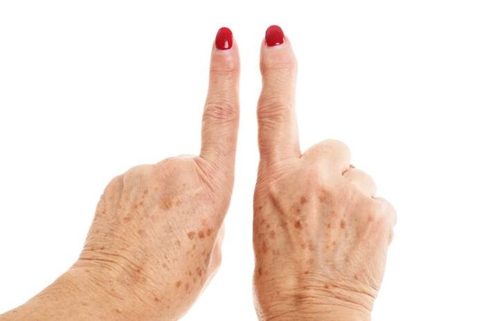дэфармавальны артроз на пальцах рук
